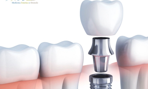 Il successo di un Impianto Dentale