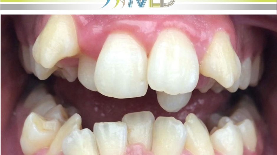 Il ruolo dell'ortodonzia nei casi di affollamento dentale