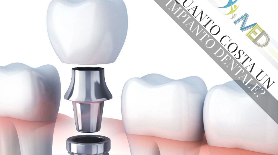Quanto costa un impianto dentale?