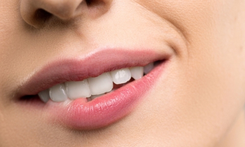 Sbiancamento Dentale
